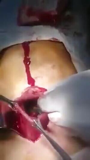 Guess what's removed from this guy's stomach