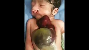Ectopic Heart In A Newborn