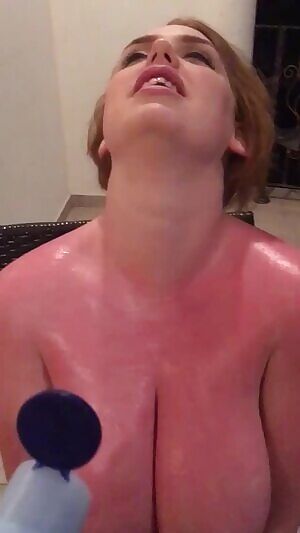 Sunburn