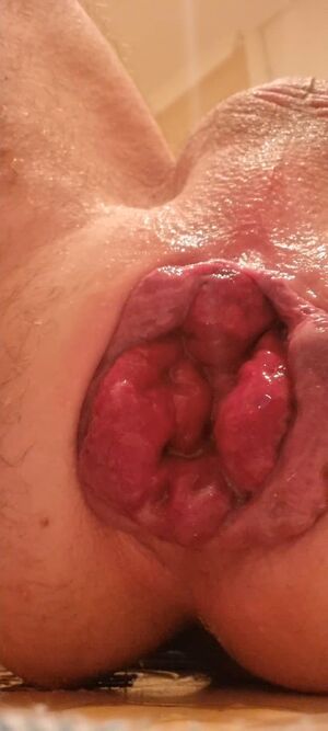 Prolapses Anal Ass Spread Close Up