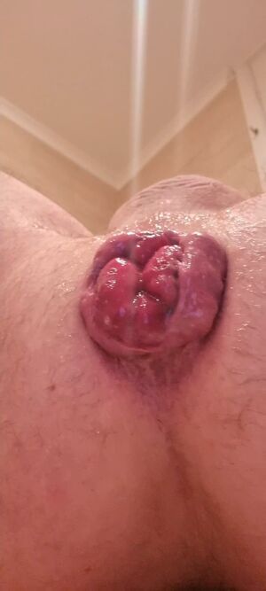 Prolapses Anal Close Up Male Prolapse