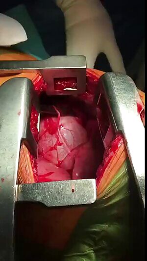 Chest opened to help remove knife from heart